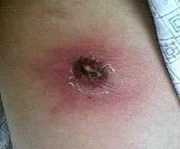 Brown recluse spider bite in the end stage showing a dark scab surrounded by irritated skin